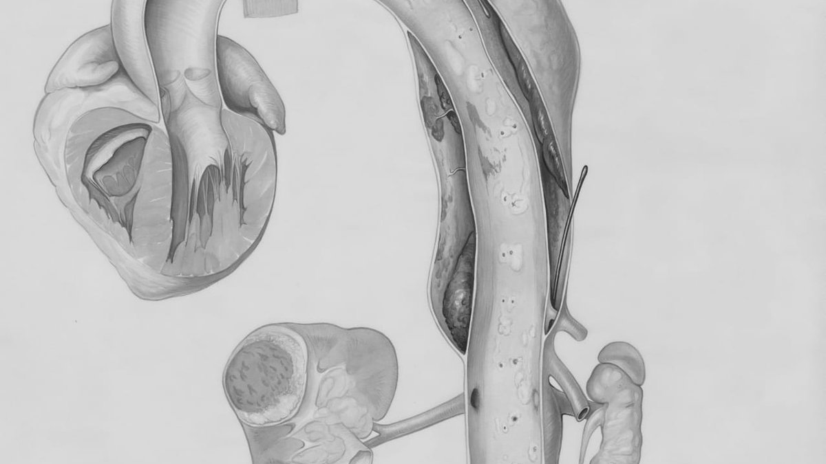 Medical diagram showing an aneurysm in the aorta