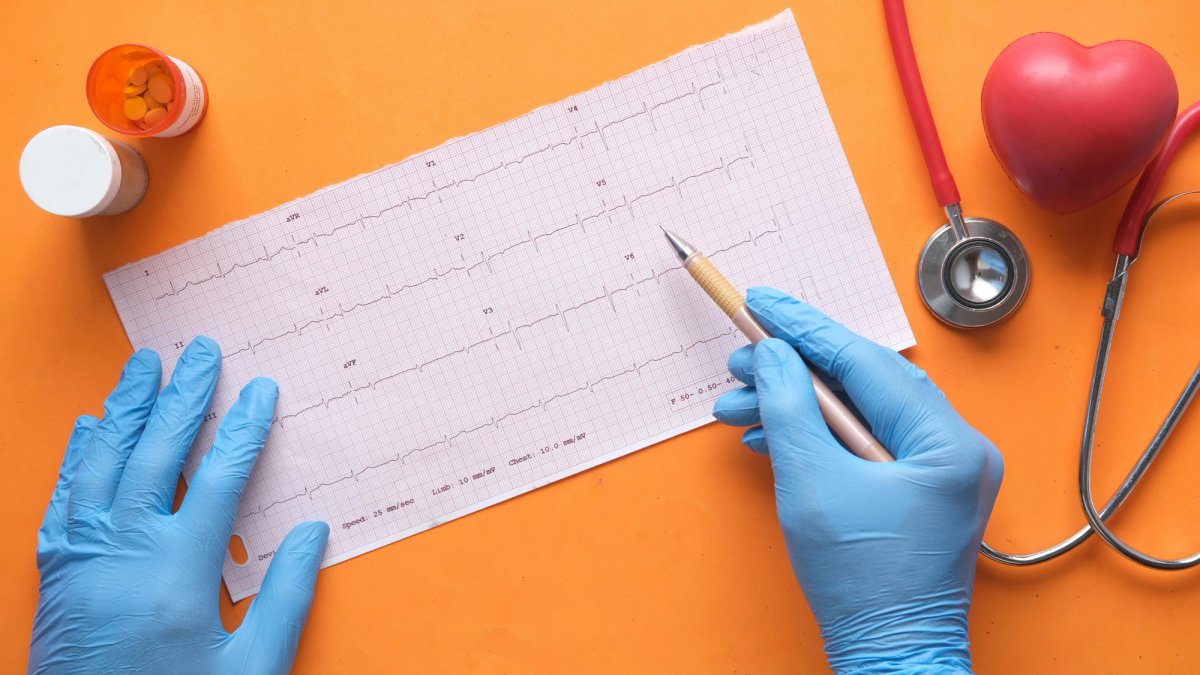 ECG trace illustrating an irregular heartbeat characteristic of an arrhythmia