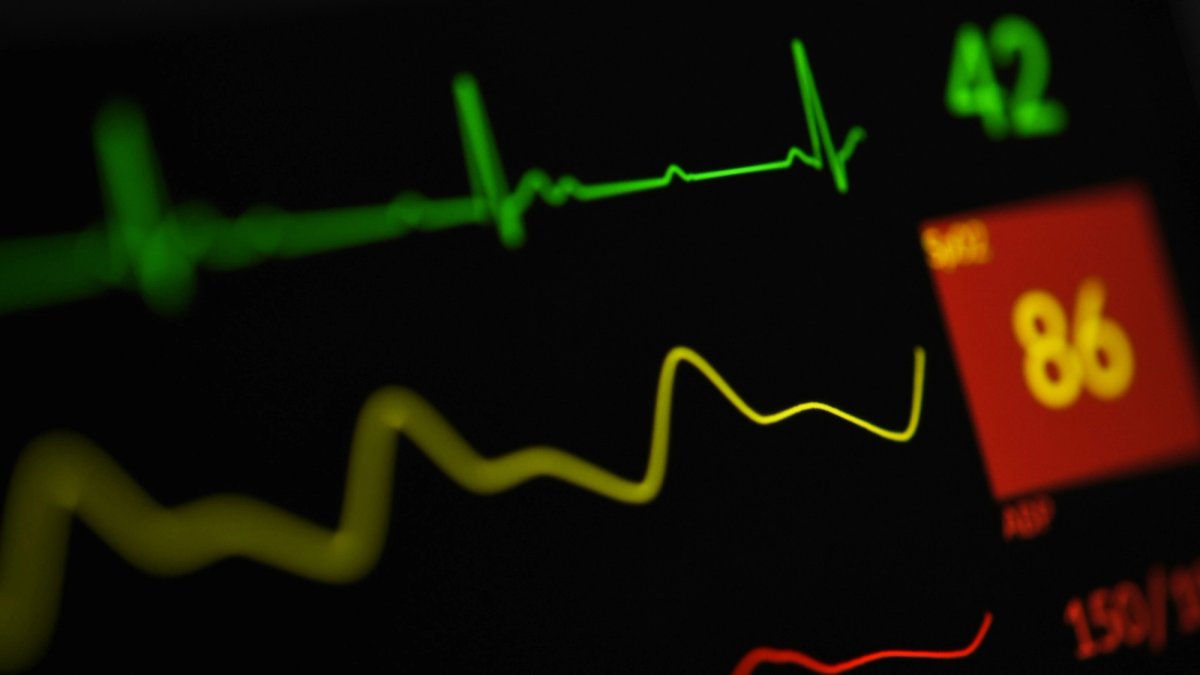 ECG reading showing the slow, spaced-out heartbeats of bradycardia