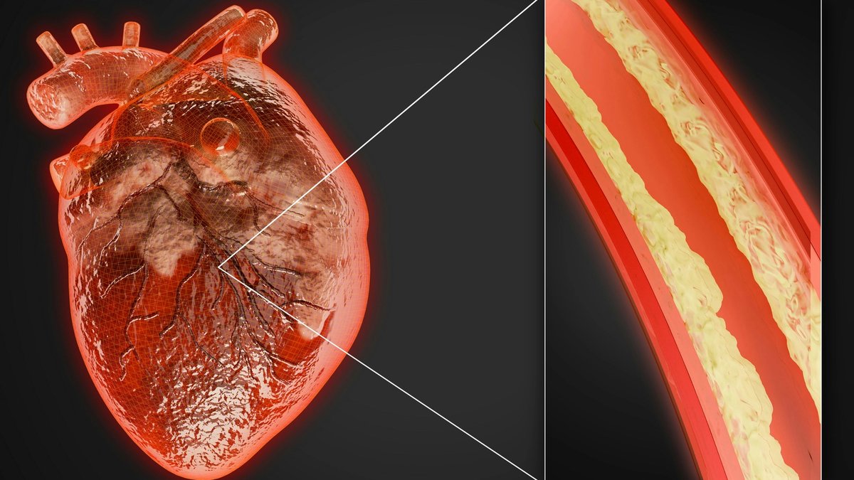 Illustration of a narrowed coronary artery due to plaque buildup