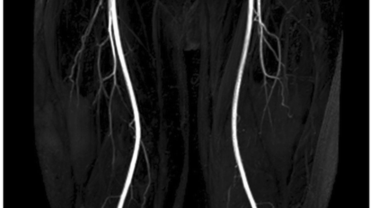 Illustration showing reduced blood flow in the leg due to peripheral artery disease