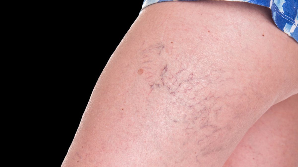 Spider veins visible on the surface of the skin