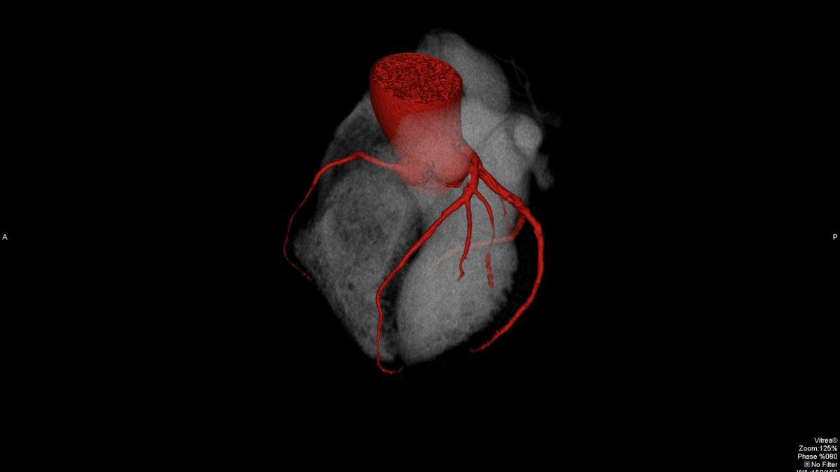 High-resolution 3D scan of the heart from a cardiac CT angiography