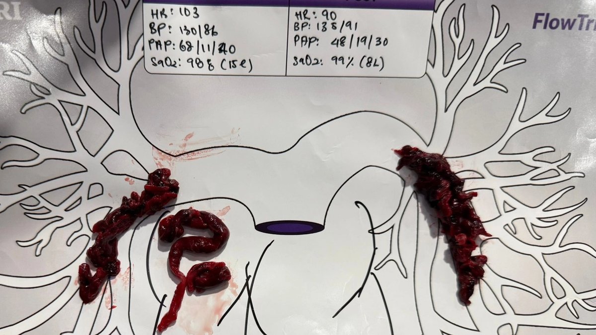 Mechanical thrombectomy catheter removing a massive clot from the pulmonary artery
