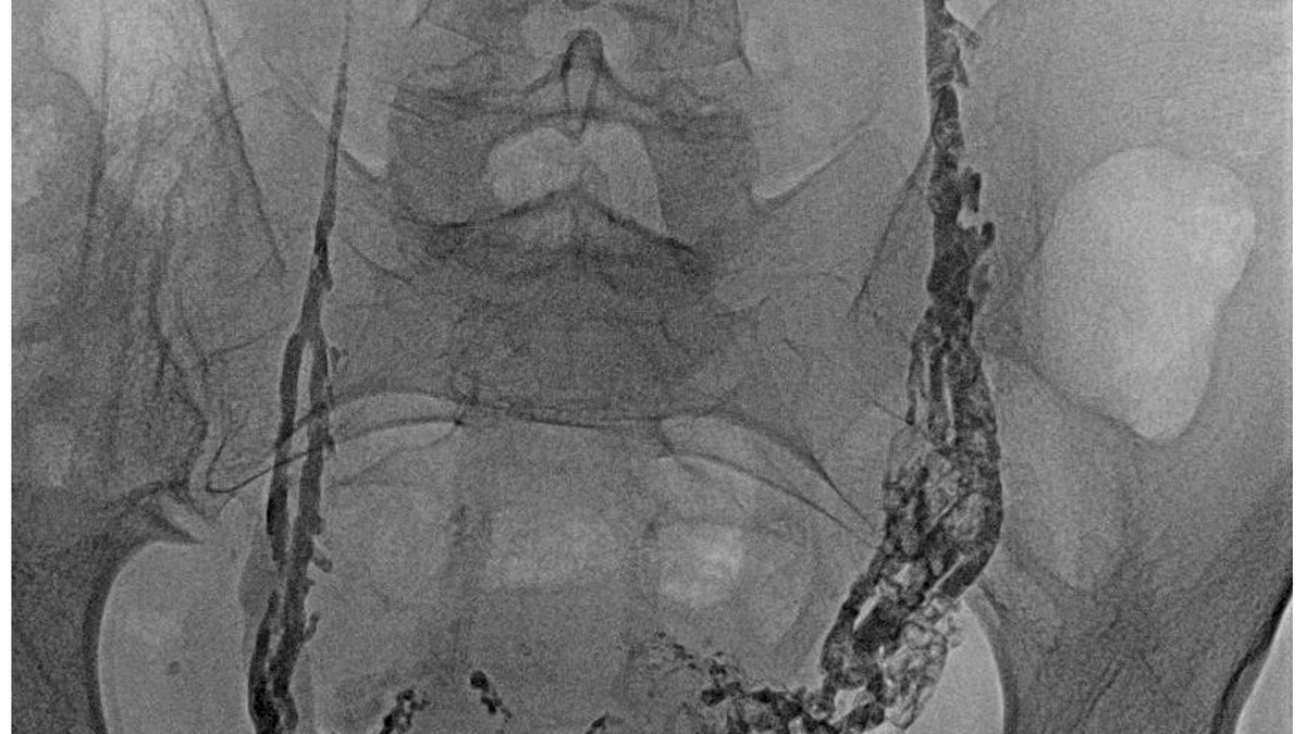 Medical diagram showing embolisation coils placed within enlarged pelvic veins