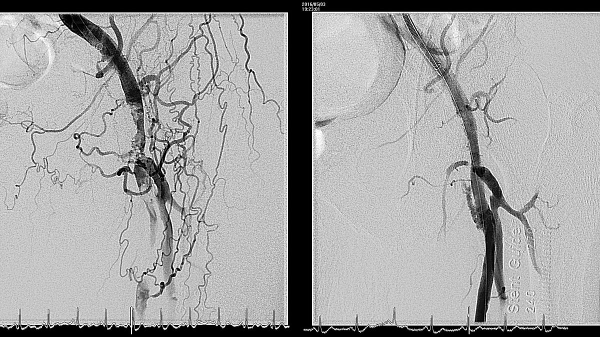 Diagram showing peripheral angioplasty clearing a blocked artery in the leg